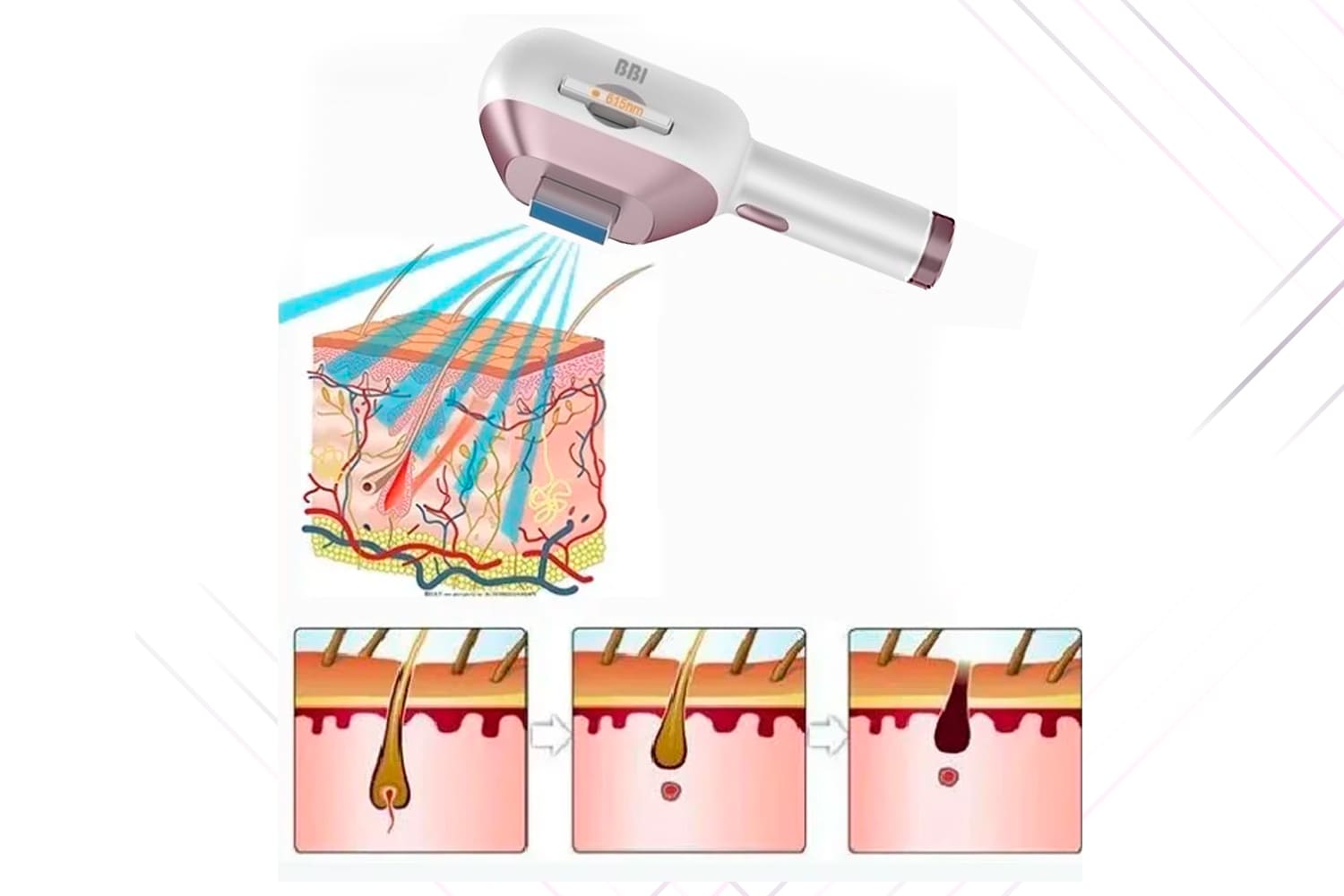 Апарат для фотоепіляції з технологій IPL