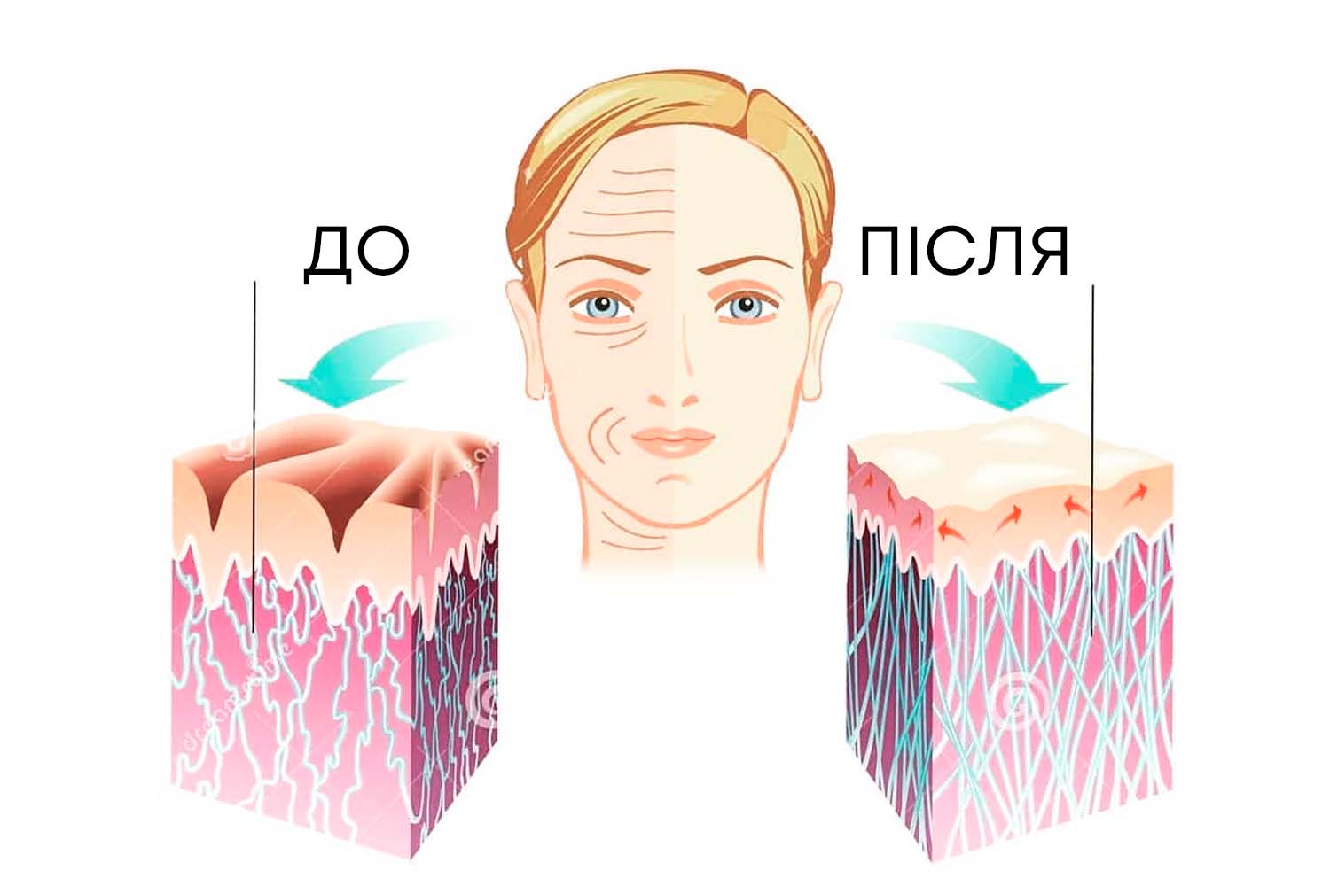 Особенности  rf-лифтинга